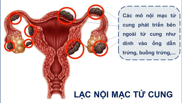 Hình ảnh cho thấy các mô nội mạc tử cung phát triển ở bên ngoài tử cung